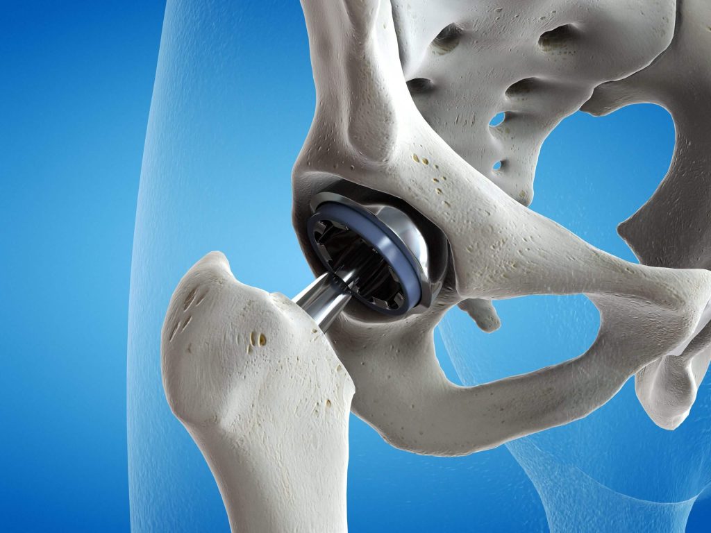 Hip-Replacement-Surgery-Dubai - https://drpaulmacnamara.com/