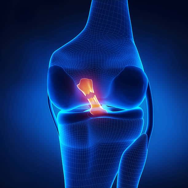 Medial meniscal tear | Dr. Paul Macnamara consulting a knee replacement patient in Dubai