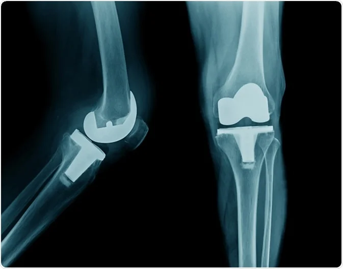 shutterstock 614362403 | Dr. Paul Macnamara consulting a knee replacement patient in Dubai